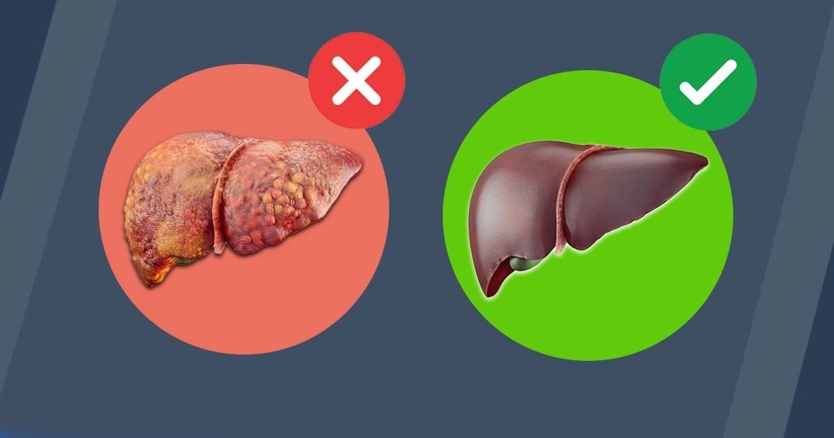 Liver detox – this is how to get rid of belly fat